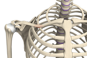Malunion Surgery of the Shoulder