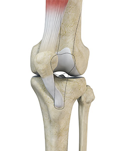 Medial Patellar Instability