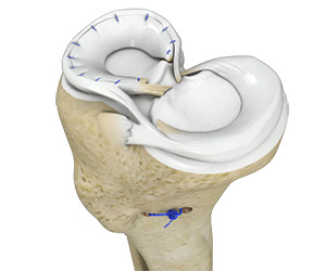 Meniscal Surgery
