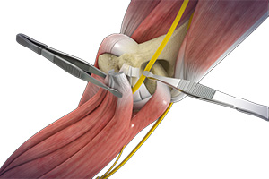 Open Cubital Tunnel Repair