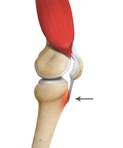 Osgood-Schlatter Disease