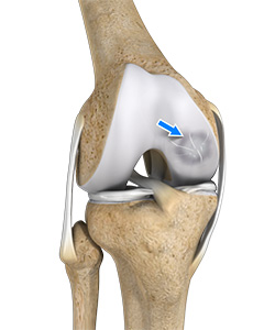 Osteochondral Defect of the Knee