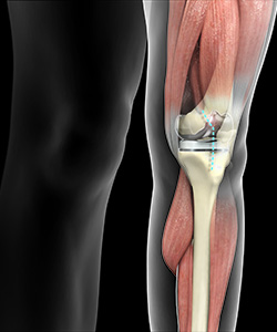 Outpatient Total Knee Replacement