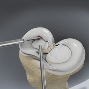 Partial Meniscectomy