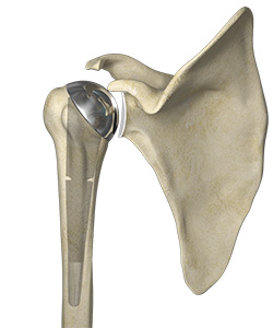 Partial Shoulder Replacement