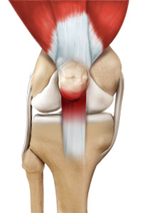 Patellar Tendinitis