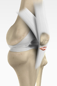 Patellar Tendon Rupture
