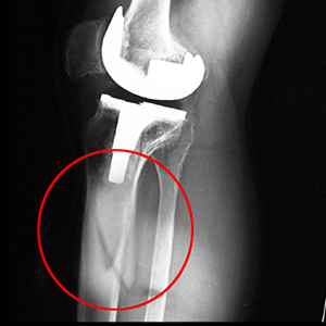 Periprosthetic Knee Fractures
