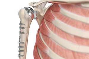 Periprosthetic Shoulder Fracture Fixation