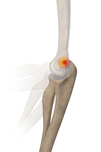 Posterior Impingement of the Elbow