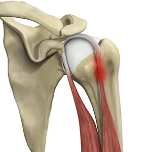 Proximal Biceps Tendinitis