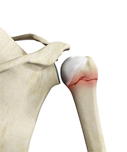 Proximal Humerus Fractures
