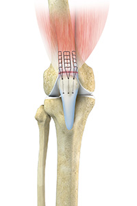 Quadriceps Tendon Repair