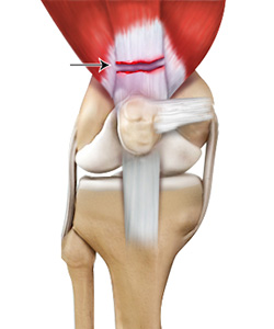 Quadriceps Tendon Rupture