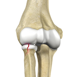 Radial Head Fractures of the Elbow