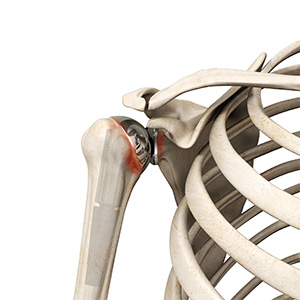 Revision Shoulder Replacement