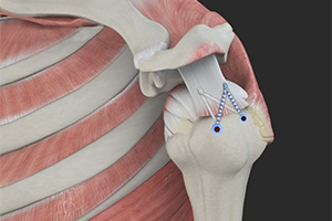 Rotator Cuff Repair