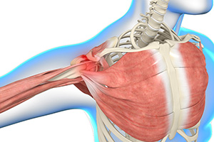 Shoulder Impingement
