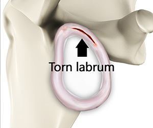 Shoulder Labral Tear