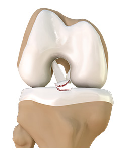 Tibial Eminence Fracture
