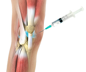 Viscosupplementation