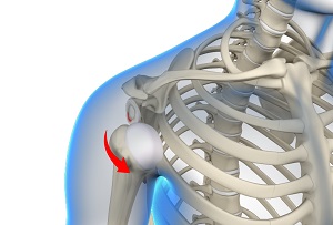 Anterior Shoulder Stabilization