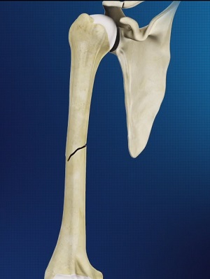 Humeral Shaft Fracture Repair