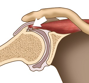 Internal Shoulder Impingement