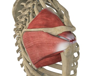 Massive Retracted Rotator Cuff Tear