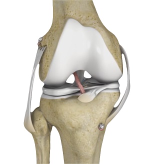 Multiligament Reconstruction of the Knee
