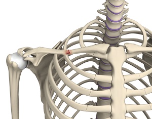 Nonunion Fixation of a Shoulder Fracture