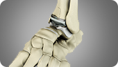 Ankle Joint Replacement