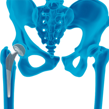Anterior Hip Replacement