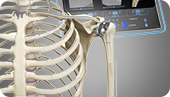 Computer Navigation for Shoulder Replacement