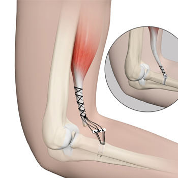 Distal Biceps Repair