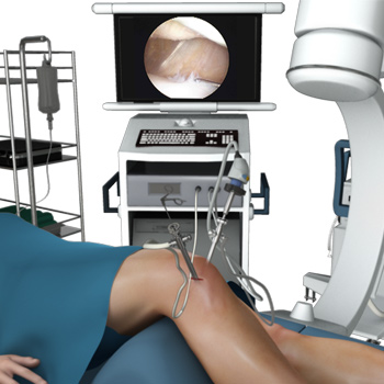 Knee Arthroscopy