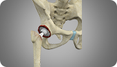 Revision Hip Replacement