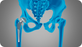 Robotic Total Hip Replacement