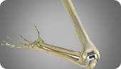 Total Elbow Replacement