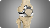 Total Knee Replacement