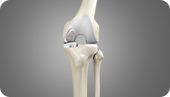Unicondylar (Partial) Knee Replacement