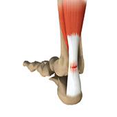 Achilles Tendon Ruptures