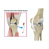 ACL Reconstruction