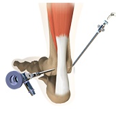 Ankle Arthroscopy