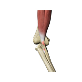 Biceps Tenodesis