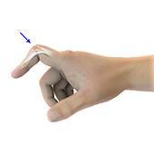 Boutonniere Deformity