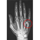 Boxer’s Fracture