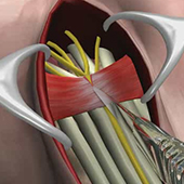 Carpal Tunnel Release Surgery
