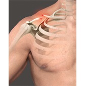 Clavicle Fracture