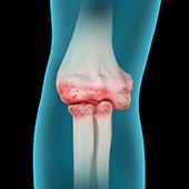 Elbow Arthritis